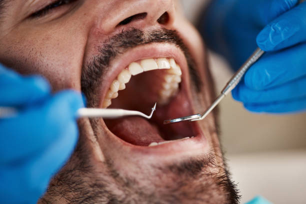 Best Emergency Dentist for Lost Fillings or Crowns in Andusia, AL